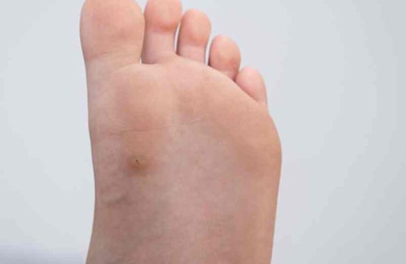 À quoi ressemble une verrue plantaire morte ?