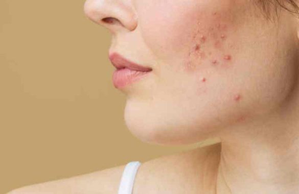 Bouton qui ne part pas depuis des mois : causes possibles et traitements